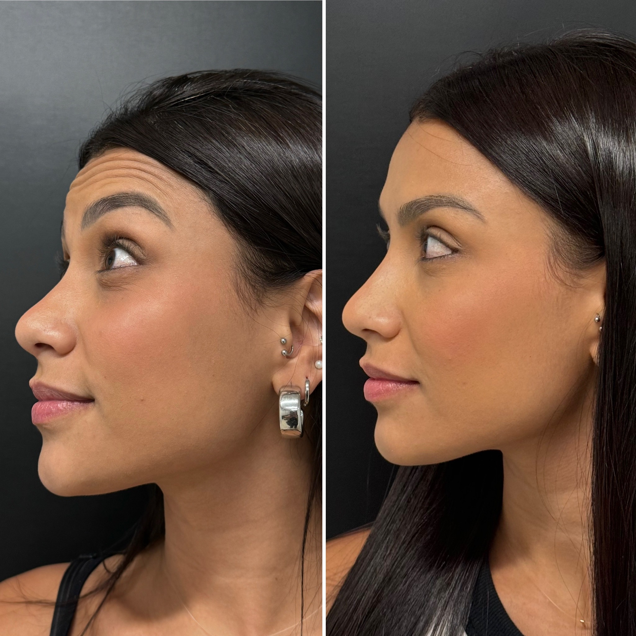 Antes e Depois — Caso 1