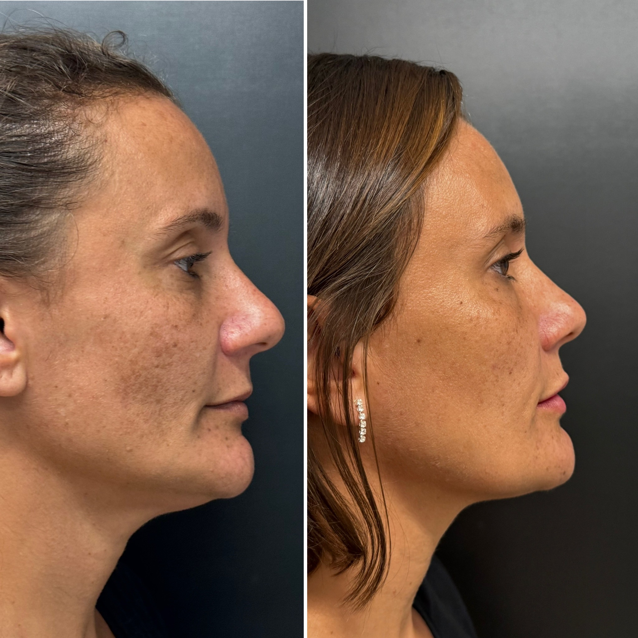 Antes e Depois — Caso 2